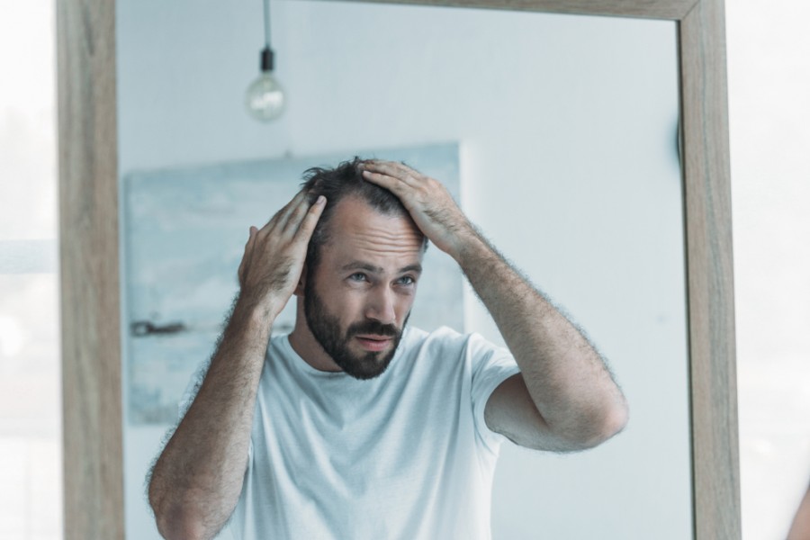 Causes et solutions de la perte de cheveux chez l'homme !